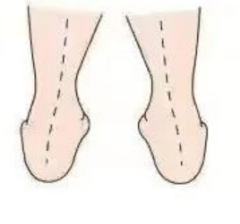 足部畸形影响孩​子的一生，花1分钟自测中招没休闲区蓝鸢梦想 - Www.slyday.coM