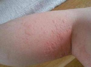 皮肤红肿,发痒,如果长时间生活在甲醛浓度超标的环境下,就会形成过敏