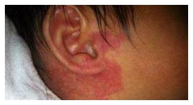 现在很多宝宝身上都会长胎记准妈妈要注意什么要怎么做呢