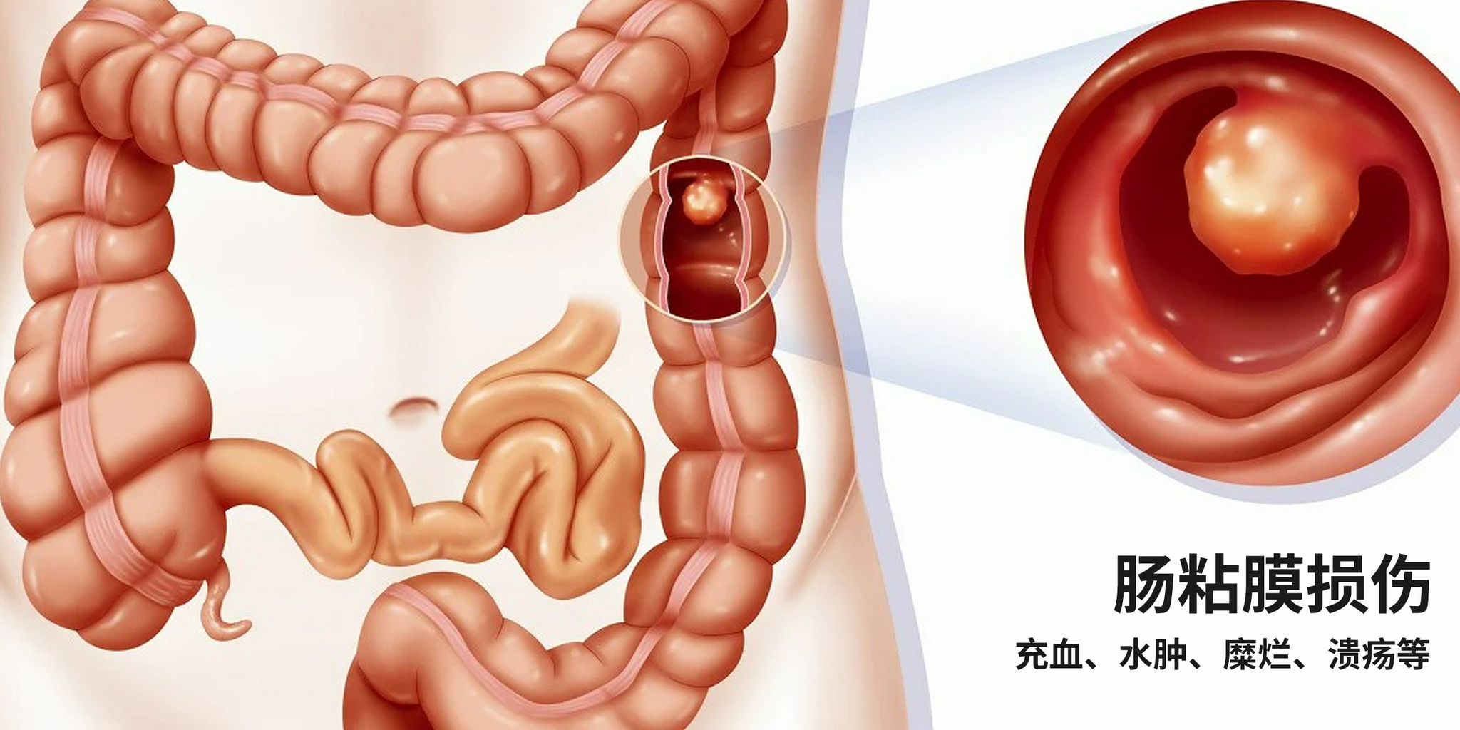 肠黏膜损伤可表现为充血,水肿,糜烂,溃疡等