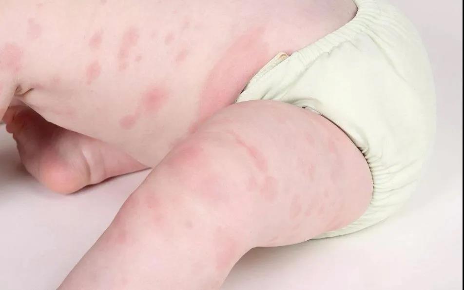 "过敏宝宝"越来越多怎么办?就用这3招!