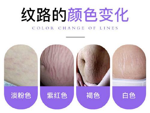 难看的妊娠纹刚开始是紫红色,慢慢会变成白色,严重影响妈妈们的爱美心