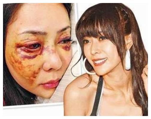 被家暴的八位明星,她结婚13天被丈夫砍掉手指,怀孕15周被踢流产