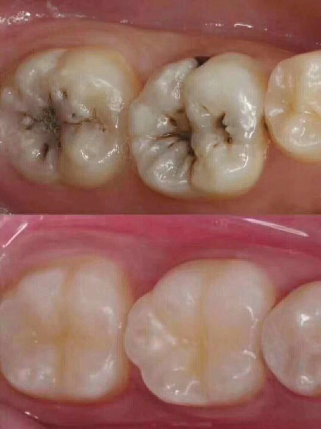 补牙,嵌体修复,根管治疗,拔残根,智齿顶断大牙!你是哪种?