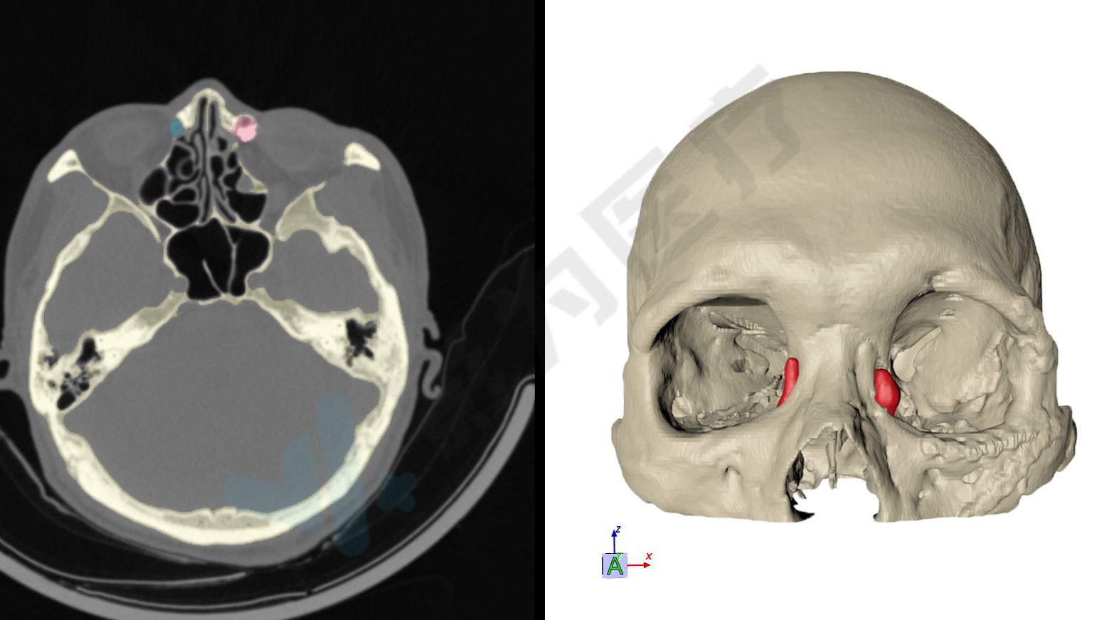 三维重建头颅模型没有地形图的作战就如同盲人摸象,影为工程师在收到