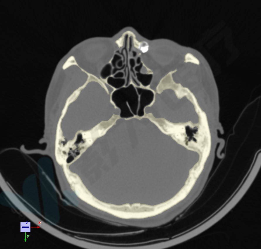 医生在术前只能通过ct扫描后得到的二维切片观察和测量鼻泪管的解剖