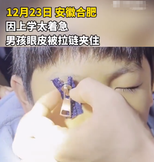 哭笑不得!安徽一小学生着急上学,眼皮被拉链夹住,这是多想去学校休闲区蓝鸢梦想 - Www.slyday.coM 哭笑不得!安徽一小学生着急上学,眼皮被拉链夹住,这是多想去学校休闲区蓝鸢梦想 - Www.slyday.coM