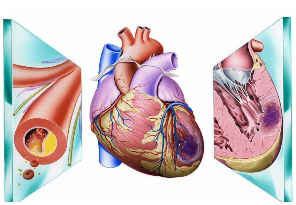 好端端一个人，为何突发心梗离世呢？医生：这1食物是“祸根”休闲区蓝鸢梦想 - Www.slyday.coM