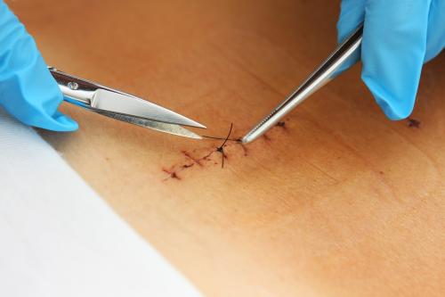 每逢下雨天,剖宫产后的刀口都会发痒,是手术做坏了吗?