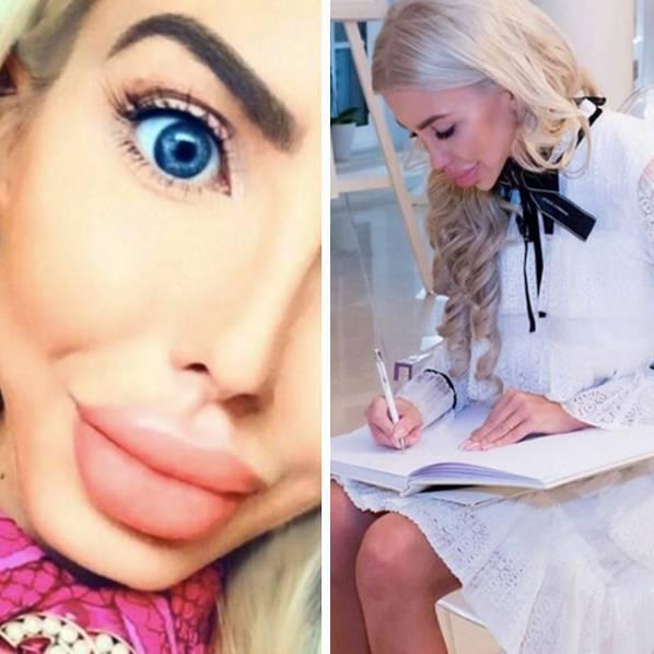 女子花费26万元整容成芭比娃娃整容后变成了香肠嘴