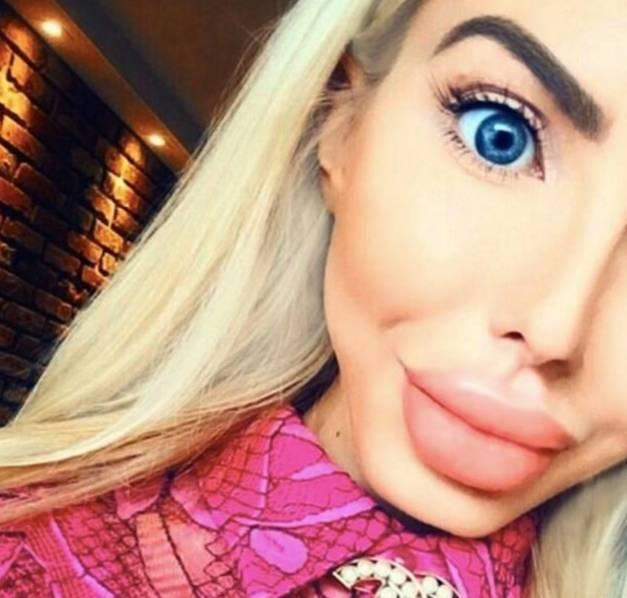 女子花费26万元整容成芭比娃娃整容后变成了香肠嘴