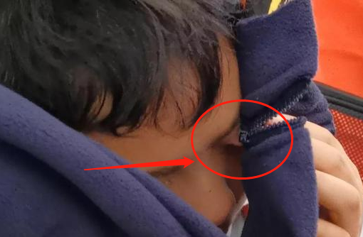 哭笑不得!安徽一小学生着急上学,眼皮被拉链夹住,这是多想去学校休闲区蓝鸢梦想 - Www.slyday.coM 哭笑不得!安徽一小学生着急上学,眼皮被拉链夹住,这是多想去学校休闲区蓝鸢梦想 - Www.slyday.coM