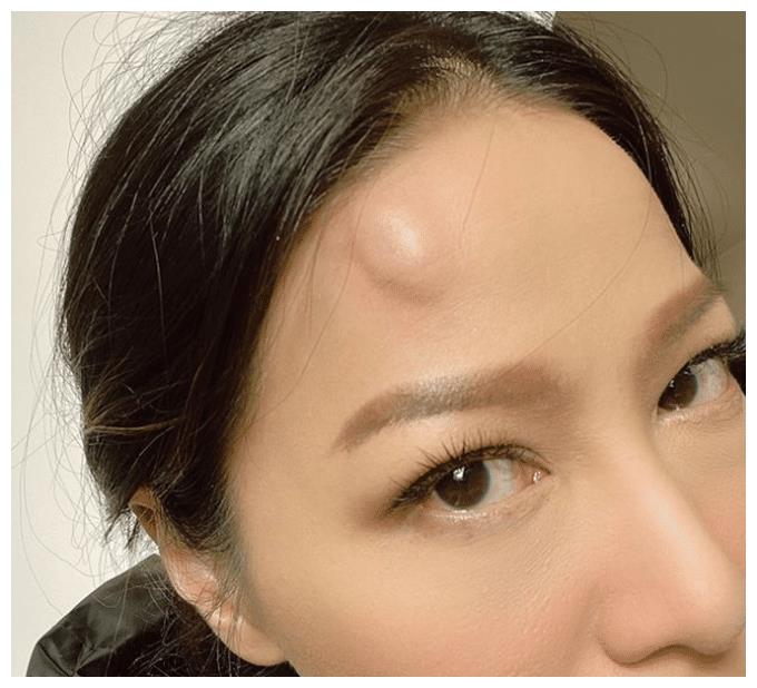 44岁滕丽名意外撞墙,额头肿包隆起,却被富商老公当成故意化妆