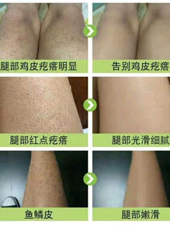 小腿上有很重的鸡皮肤(为什么小腿鸡皮肤很严重?)