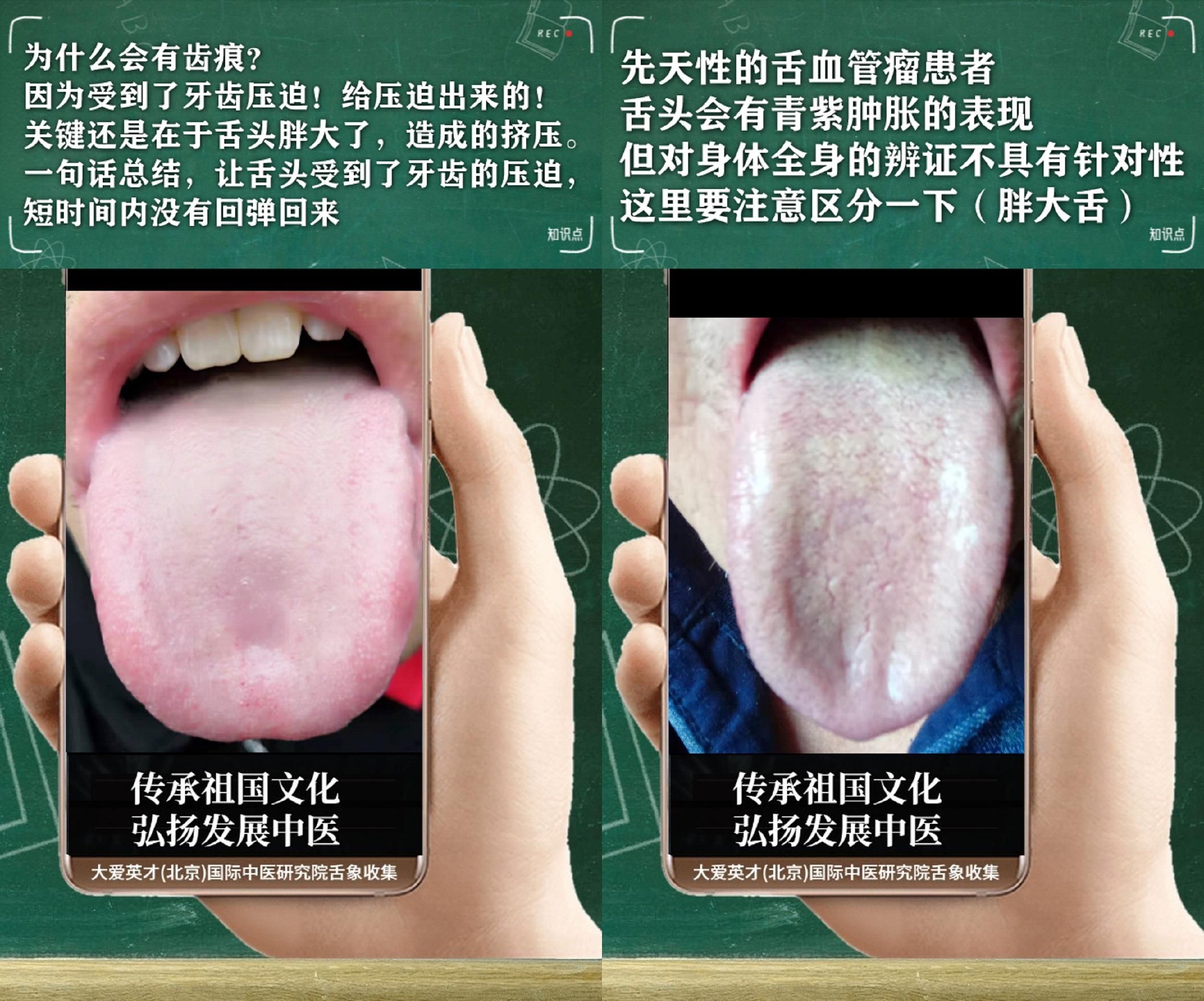 舌中裂纹的中医辨治 舌中间裂纹怎么调理 - 真有文学