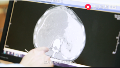 20岁女生罹患"虫癌"命悬一线,医生手动"除虫"14小时