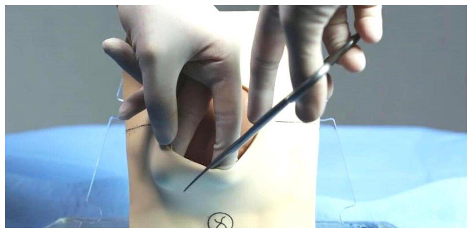 手术刚开始进行的很顺利,但是随后医生就告诉李女士孩子的头部比较大