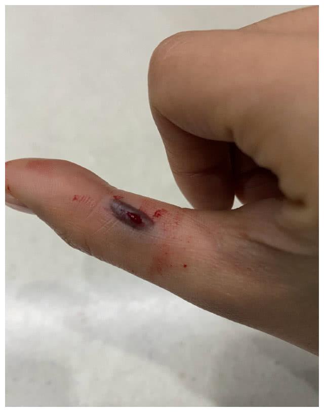 沈梦辰工作受伤,拇指被夹出血包看着都吓人,网友喊话海涛送安慰