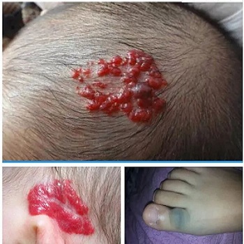 宝宝有浅色胎记如果长在比较显眼的地方,可以通过激光治疗,冷冻治疗