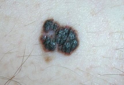 黑色素瘤是最严重的一种皮肤癌,许多ii期黑色素瘤患者术后复发的风险