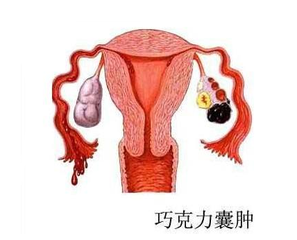 年纪小真遭罪,这个病太"羞涩"|囊肿|巧克力|卵巢_新浪新闻