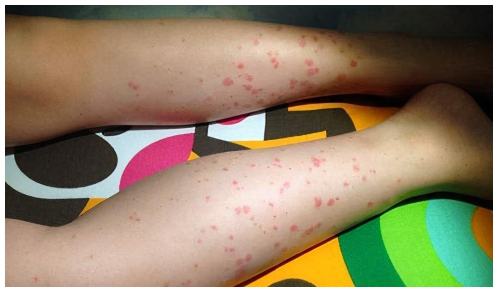 而且如果过敏性紫癜的症状比较严重,不单单会影响患者的皮肤,甚至会