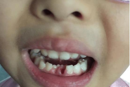 孩子长出的新牙是歪的,这是怎么回事?