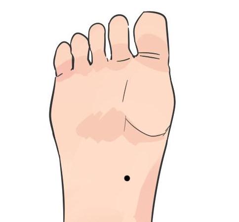 第一:脚底痣