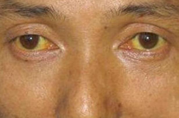 皮肤和虹膜发黄:日常生活中,胆红素在肝脏当中进行代谢,胆红素摄取