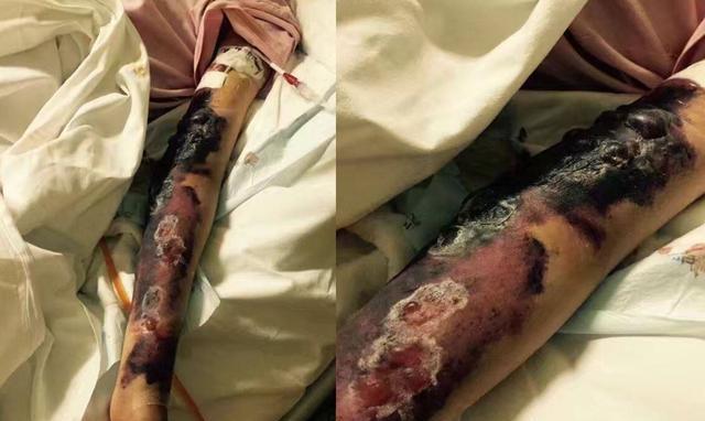 艺人徐婷被家人吸血十几年26岁患癌身体溃烂而死