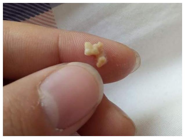 儿科医师万主任告诉芮女士,这些暗黄颗粒是扁桃体结石,容易发生在孩子