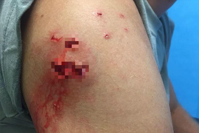 男子冲浪遭鲨鱼狠咬一口,挥拳暴揍鲨鱼后奇迹脱困