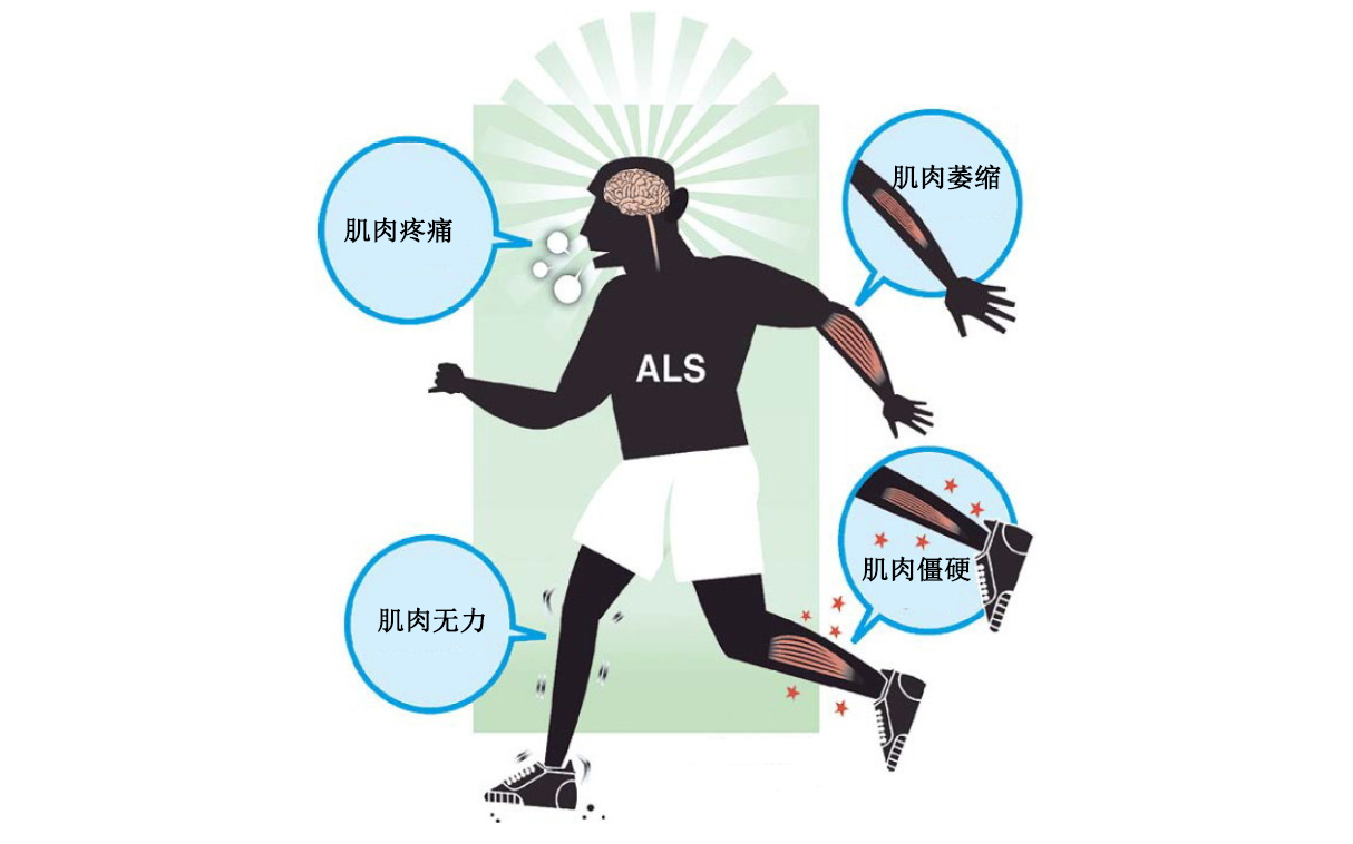 肌萎缩性脊髓侧索硬化症新药fda批准依达拉奉口服混悬液