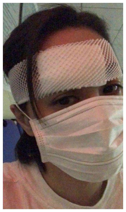 手术完毕后阿娇还拍了照片,可以看到眉骨处包扎严实,伤势令人担忧.