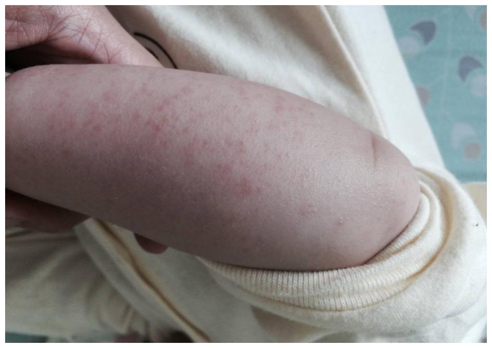 奶粉宝宝要注意过敏现象发生奶粉过敏的主要原因就是宝宝对奶粉中的