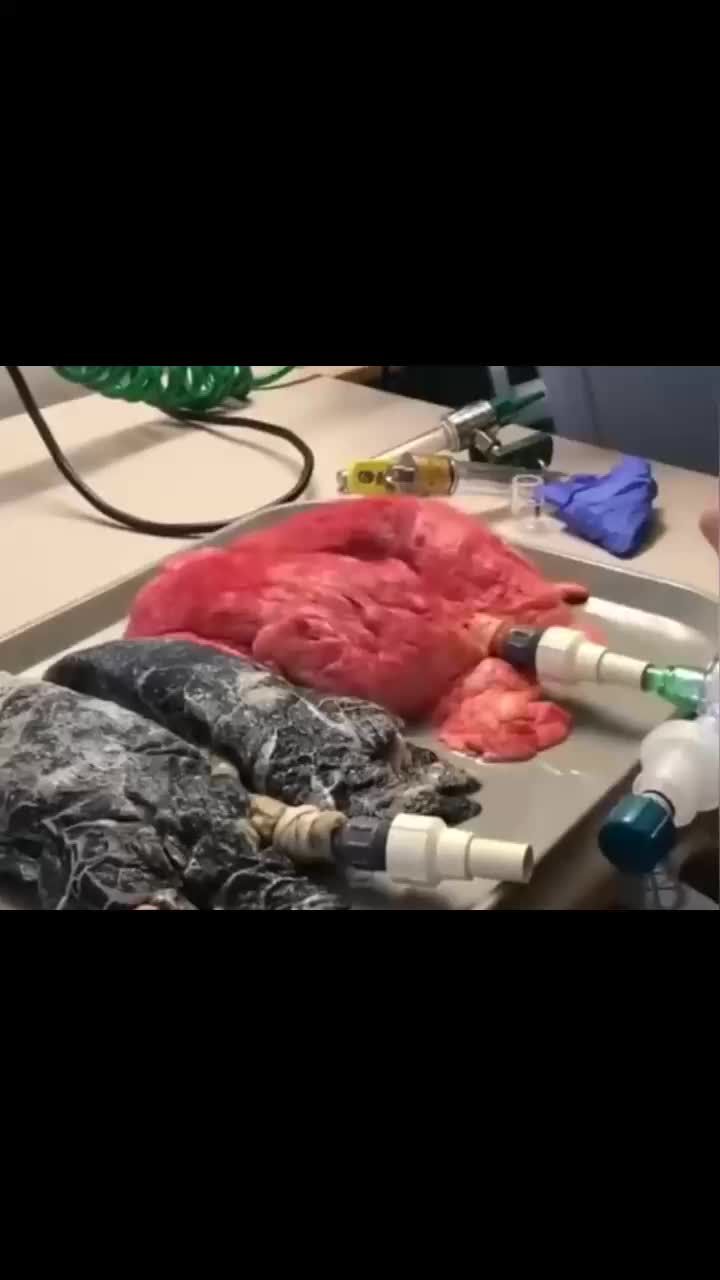 普通人和抽烟者的肺对比你看出来了吗