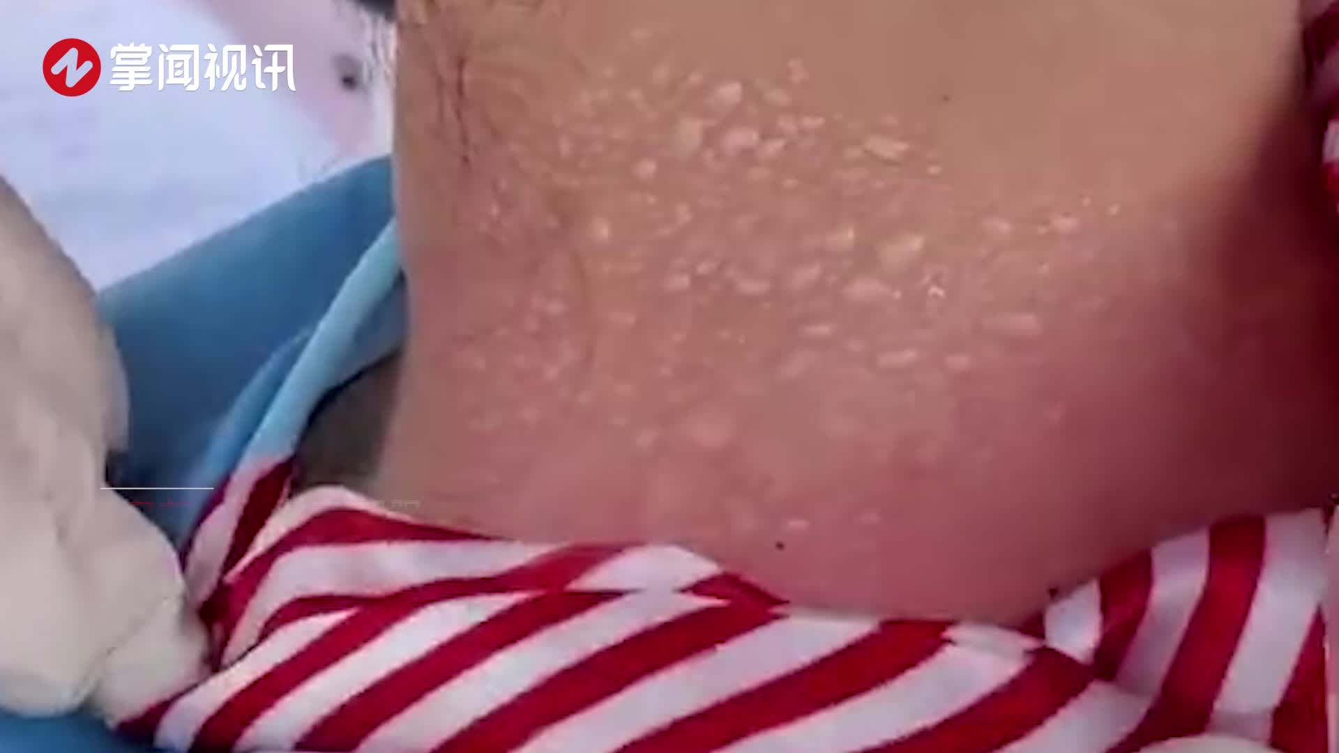 高温天里护士被晒伤脖子起密密麻麻的水泡