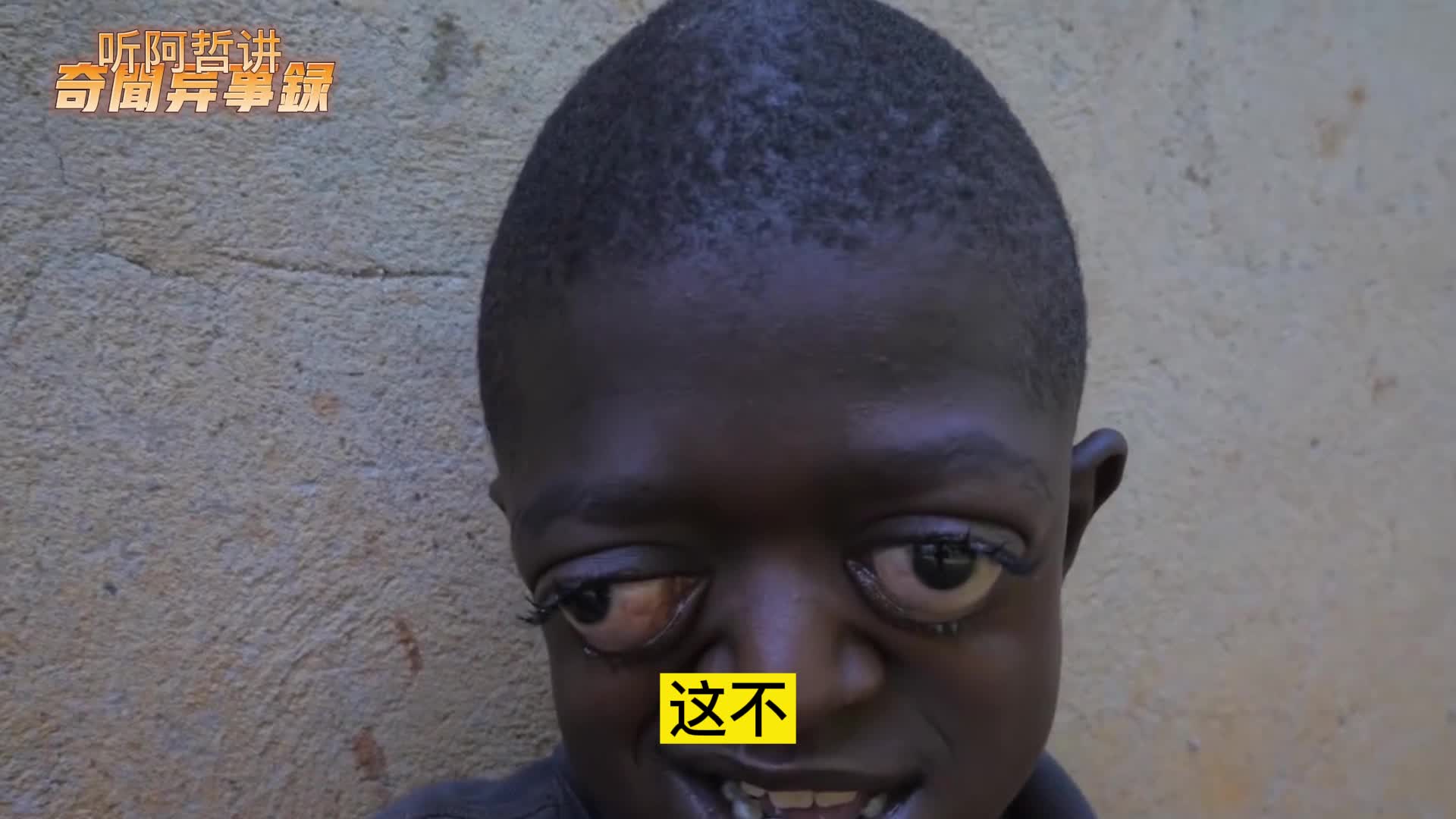 非洲男孩眼睛大的像铜铃,父亲嫌丑离家出走,亲戚建议将他安乐死