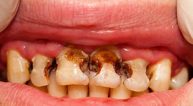 让孩子"烂牙"的不是糖,是父母的无知,必须避免三种错误行为|蛀牙|牙齿