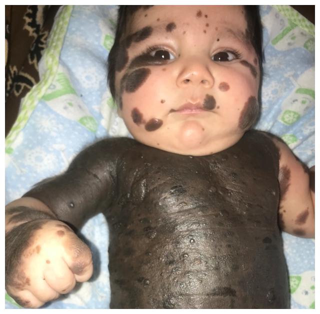 医生警告他们不知道阿尔乔姆还能活多久,因为患皮肤癌的风险很高