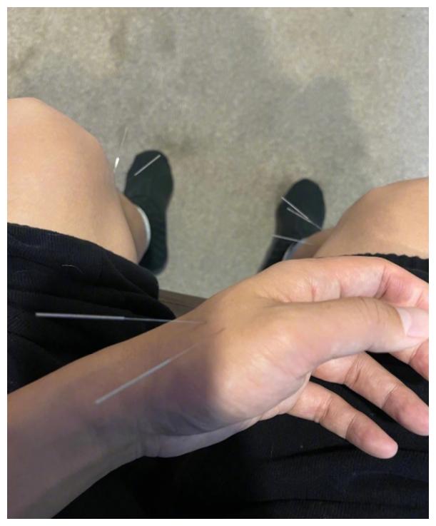 邓超陪孩子针灸直叫苦身体健康被扎14针直言下次谁爱来谁来