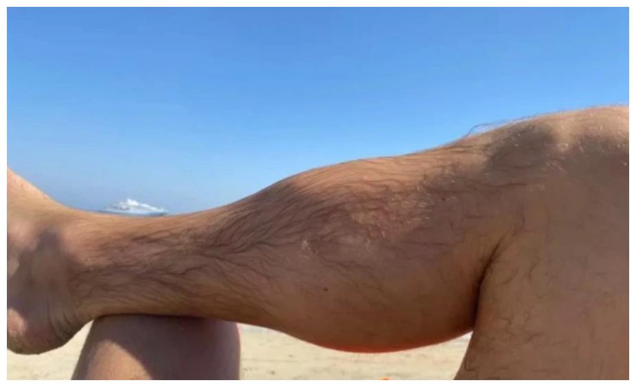 嘴炮小腿依然严重肿痛专家康纳害怕低扫害怕地面真该改打拳击