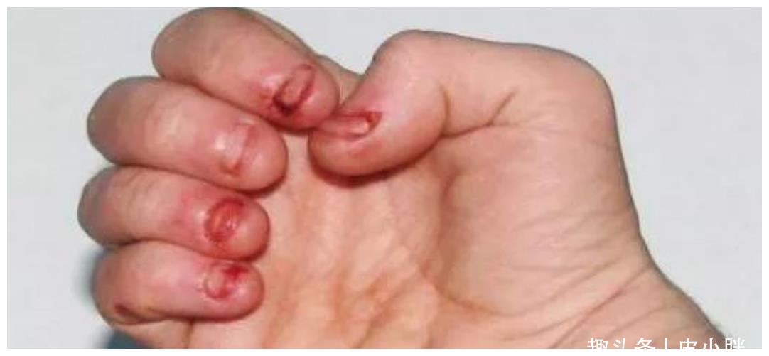 爱啃指甲的孩子长大手指都怎么样了呢医生难逃这2种结果