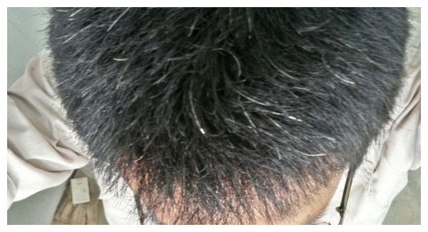 为什么头发会变白医生明确这3点之后也能变成乌黑的头发