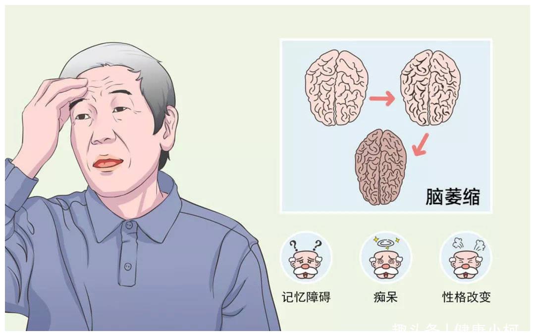 小脑萎缩是精神病吗小脑萎缩和精神病的区别揭晓