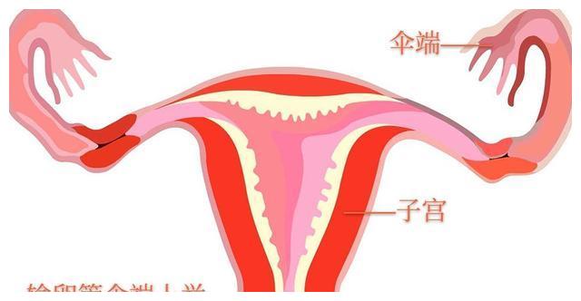 给她做了输卵管造影后,果不其然,输卵管伞端粘连上举严重