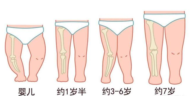 生理现象,所以也叫生理性膝内翻,一岁半以内的宝宝腿部看上去有些内翻