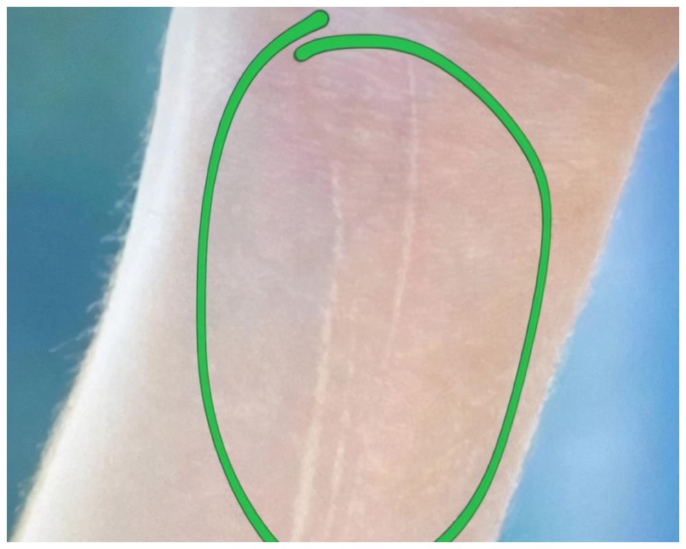 肖战手腕受伤疤痕严重上台表演意外露出曾要求修图师抠掉