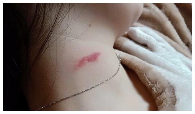脖子草莓印吻痕图片