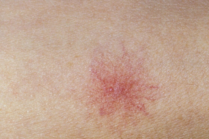 32岁女子,确诊肝硬化,医生:皮肤早有提醒,可却被她忽视了